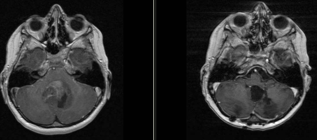 Μυελοβλάστωμα, Medulloblastoma, Μαγνητική Τομογραφία, MRI