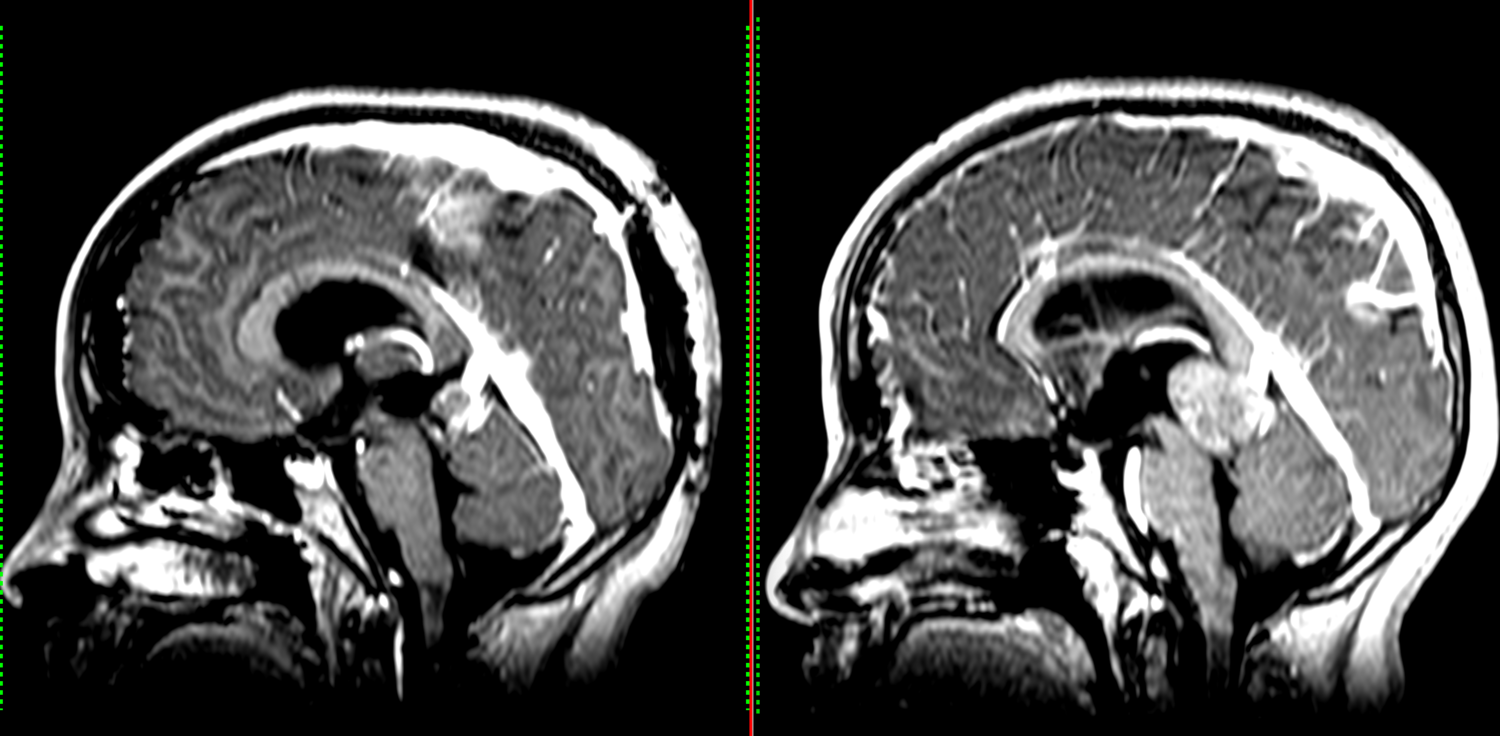 Επιφυσιοβλάστωμα, Pineoblastoma, Μαγνητική Τομογραφία, MRI