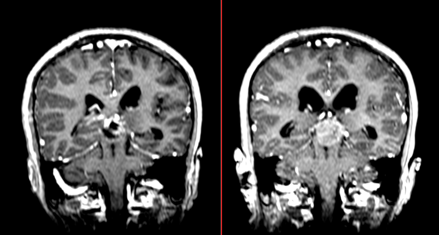 Επιφυσιοβλάστωμα, Pineoblastoma, Μαγνητική Τομογραφία, MRI